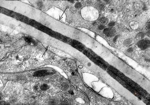 M,43y. | fungi in blood (Candida v.s.) - mycoseption